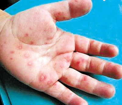 手足口病来啦家长需要了解的一些东西