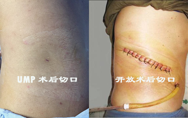 更细,需要将结石击碎成更小的碎块才能取出,对手术者的操作要求更高