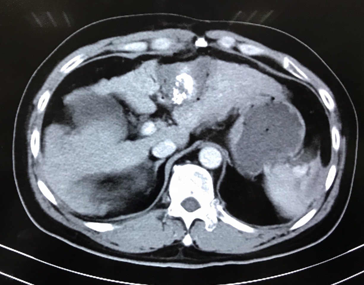 小肝癌该选择手术还是消融? - 好大夫在线