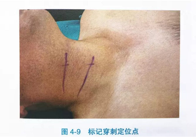 根据影像学资料以及颈部体表定位(舌骨,甲状软骨,环状软骨)初步定位