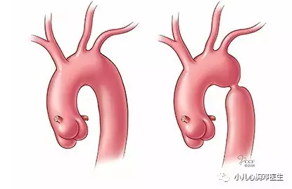 主动脉弓缩窄图片图片
