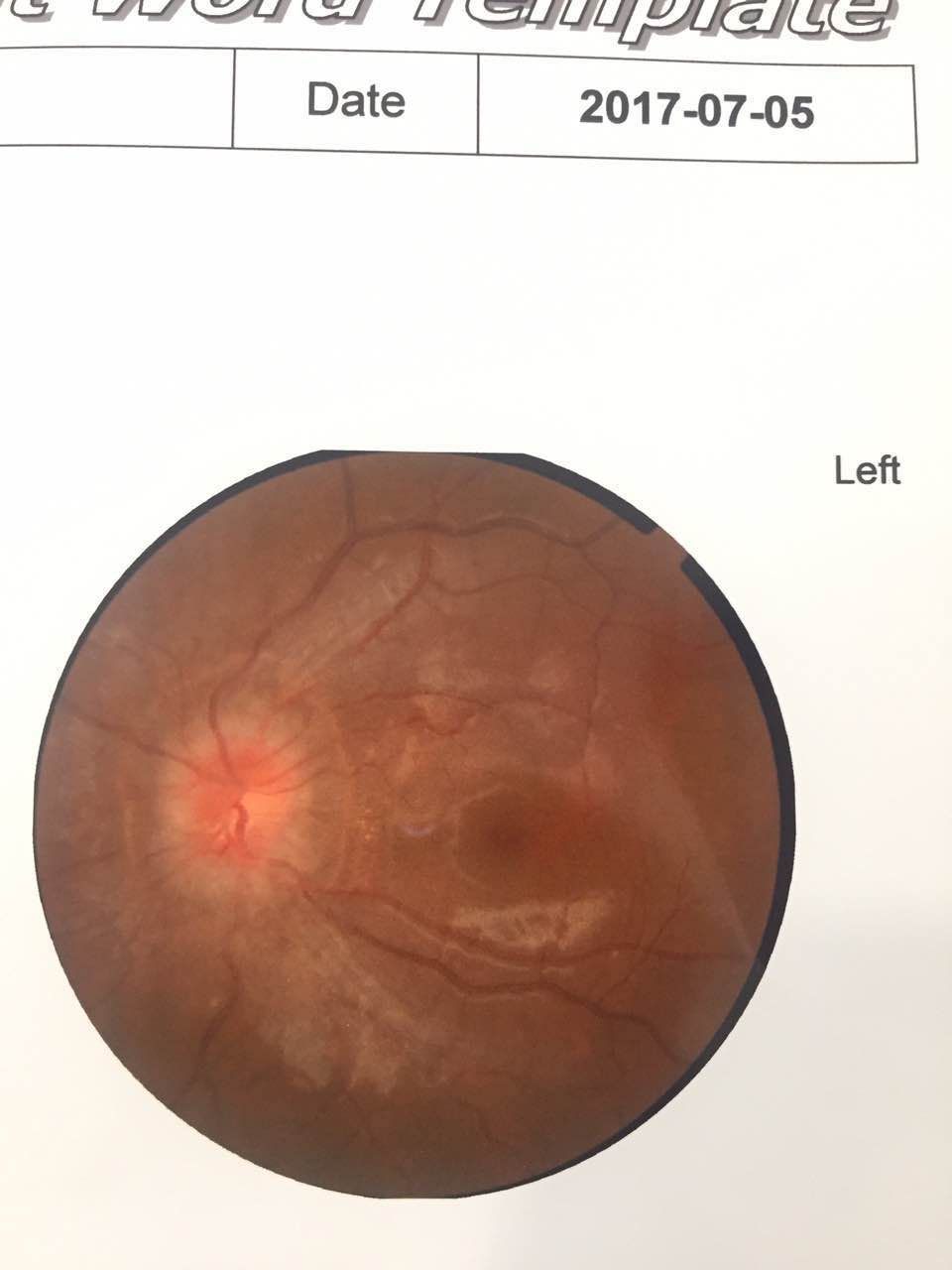 从上海华山医院转过来的一例特发性颅内高压的变化过程