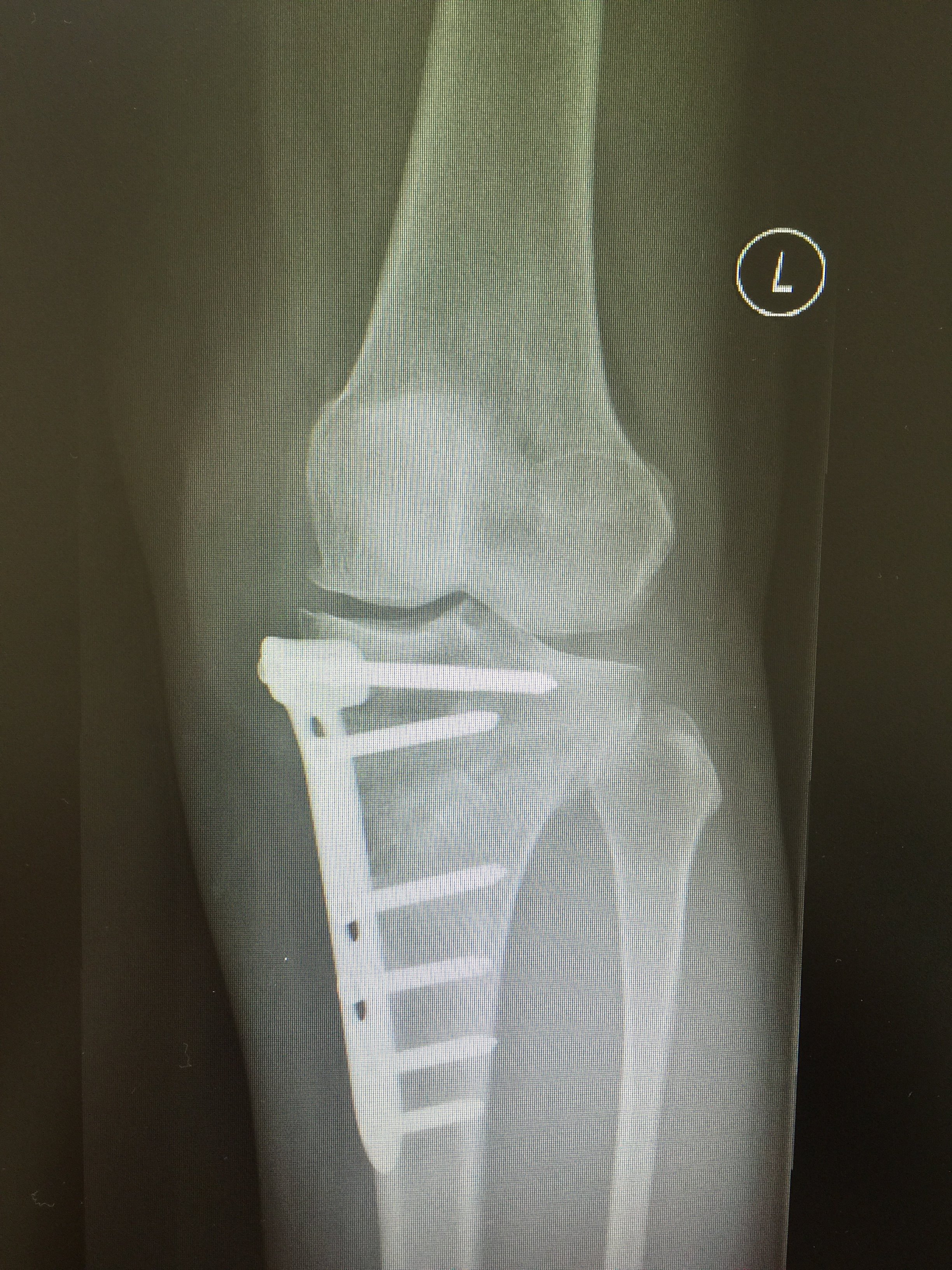 长短腿截骨手术图片图片