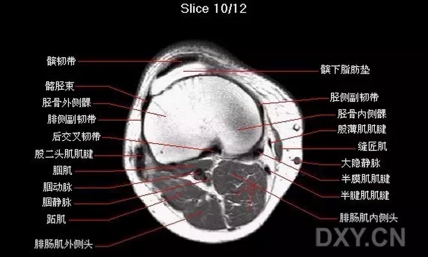 【關節影像】膝關節的磁共振(mri)解剖表現