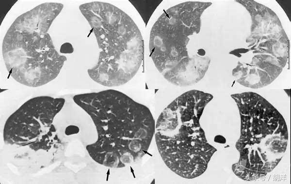 有一种真菌专门在肺部原有疾病产生的空洞里长小球