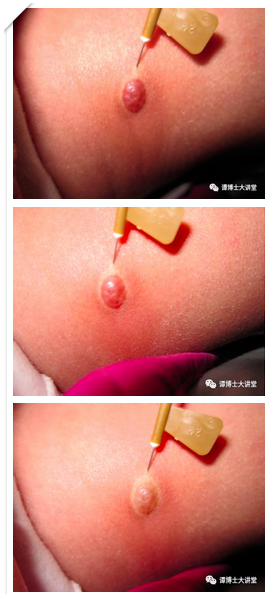血管瘤注射治疗,俗称