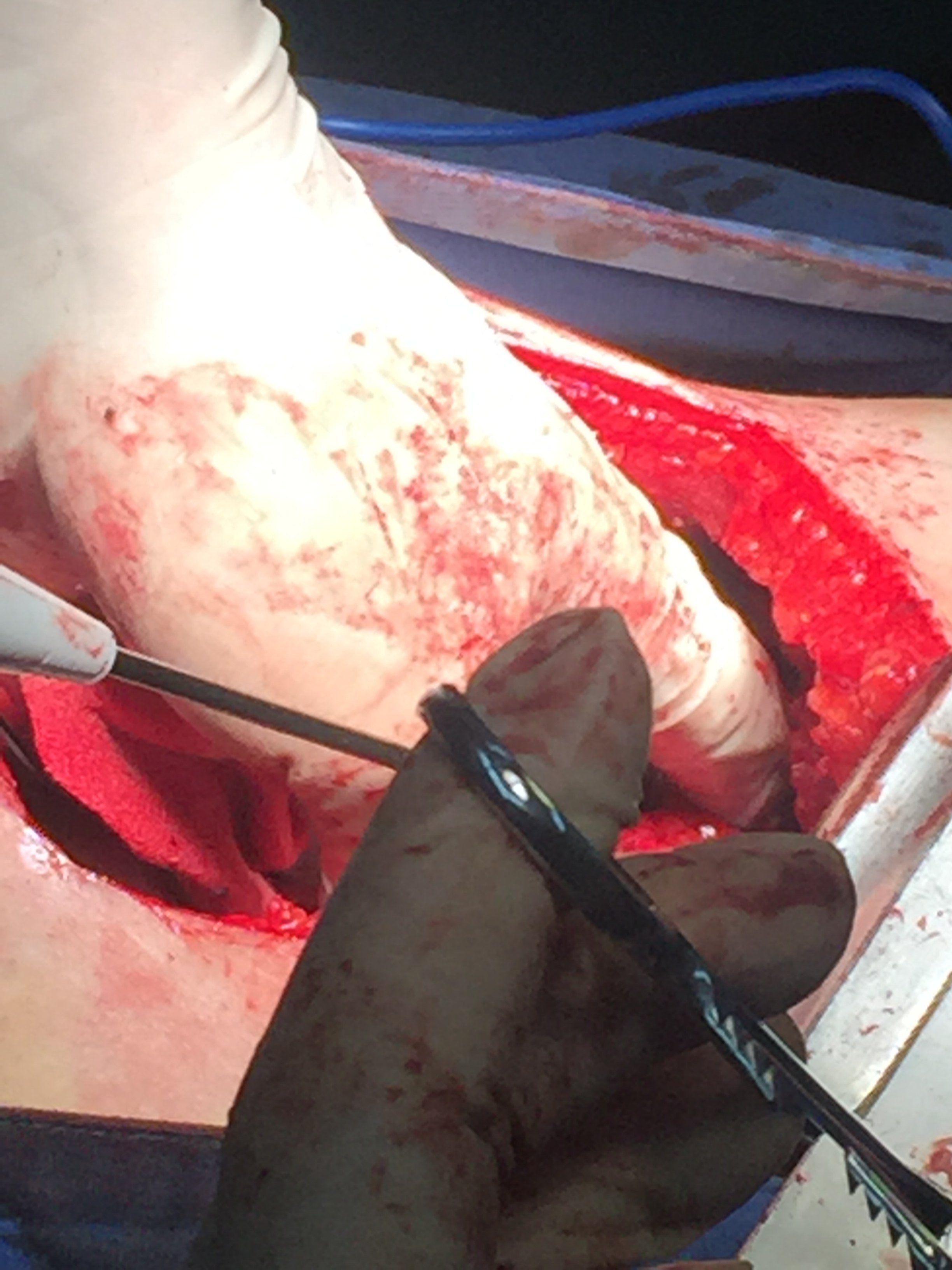 输尿管上段损伤修复3-----开放肾盂瓣成形术 - 好大夫在线