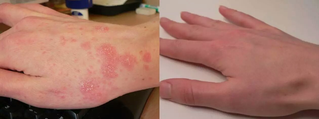 疥疮的治疗循证医学