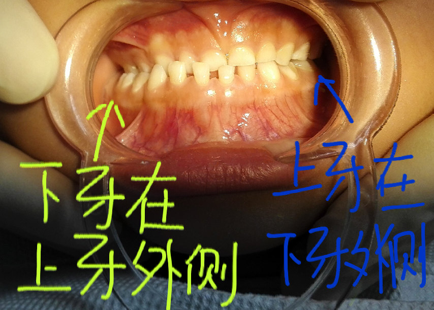 您的孩子偏侧咀嚼了么? - 好大夫在线