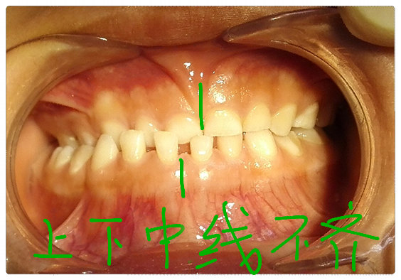 您的孩子偏侧咀嚼了么? - 好大夫在线