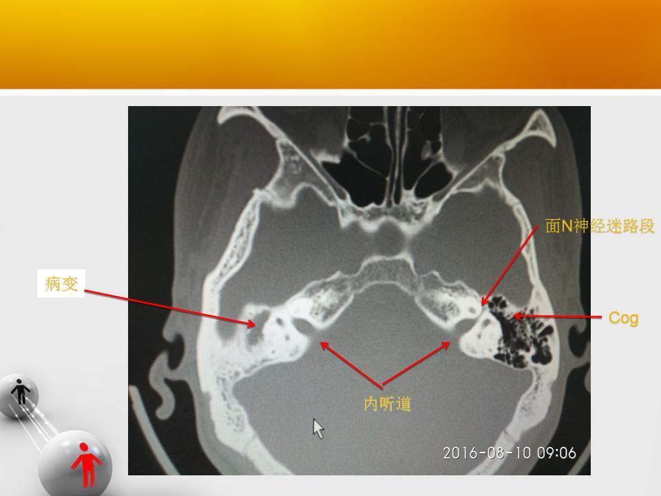 原创 颞骨断层轴位ct(完整篇)安阳市中医院耳鼻咽喉科 - 好大夫在线