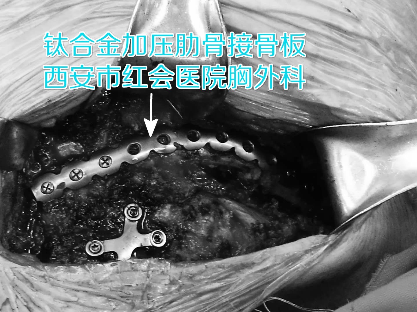二,钛合金环抱器是一种可弯曲塑形的,通过两侧边卷曲爪形结构( 每侧 4