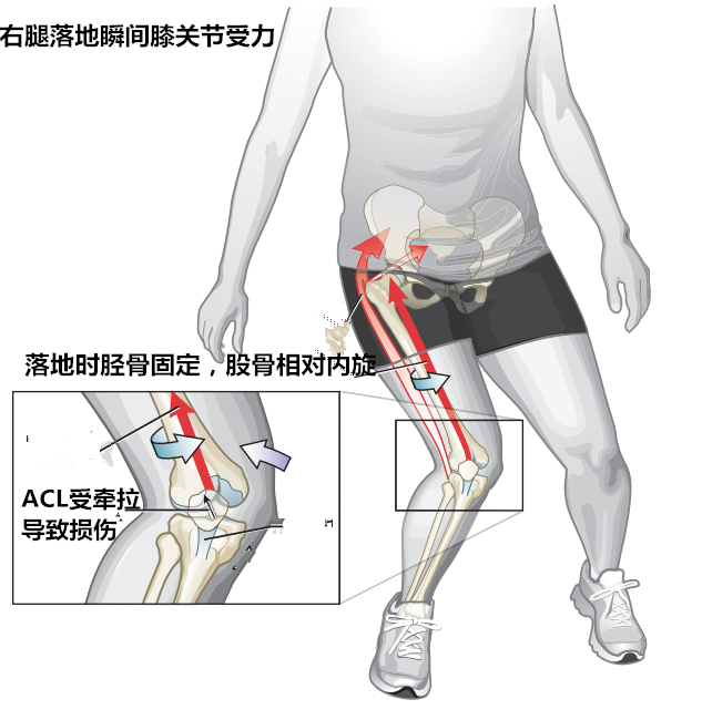 前交叉韧带为啥容易损伤损伤后要不要手术啥时手术