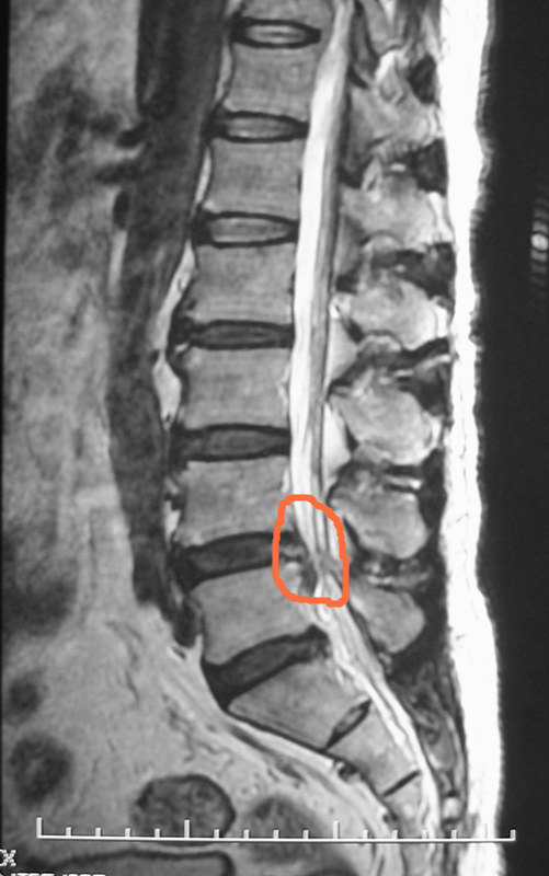 典型病例1腰椎间盘突出症