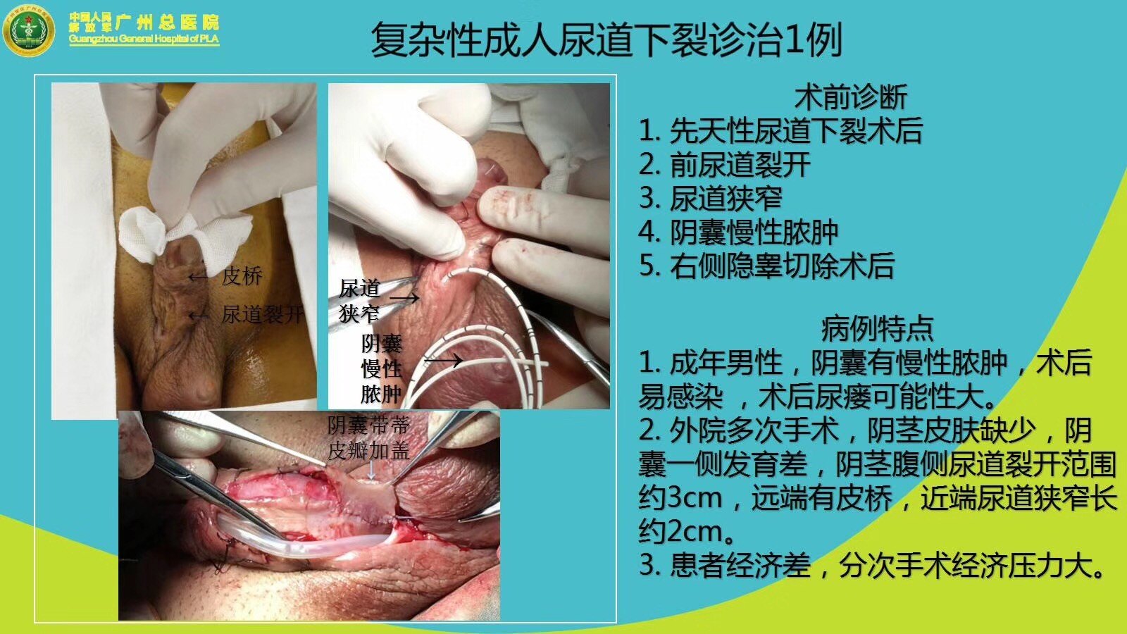 成人复杂性尿道下裂 好大夫在线