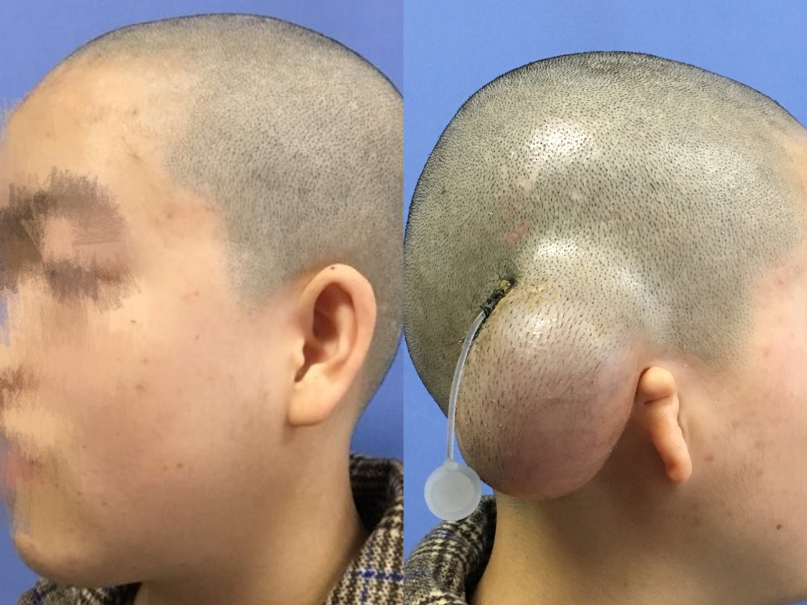 何永静博士:皮肤软组织扩张术的运用,小耳畸形耳再造 - 好大夫在线