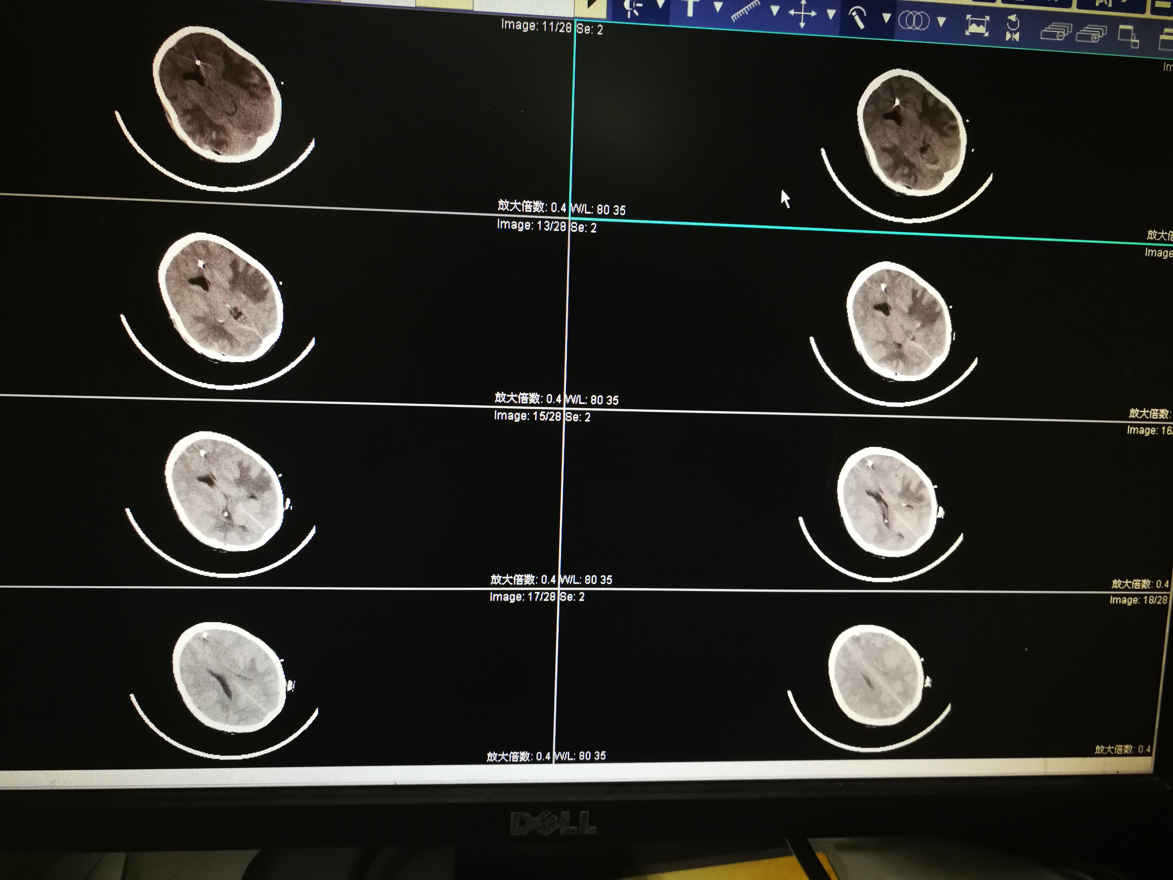 脑外伤术后颅内压监测,让我们对疾病的判断从经验走向循 - 好大夫在线