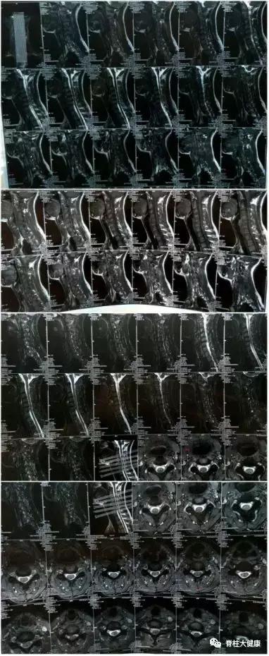 病例:颈椎反曲+脖子疼是颈椎病吗?该怎么办?