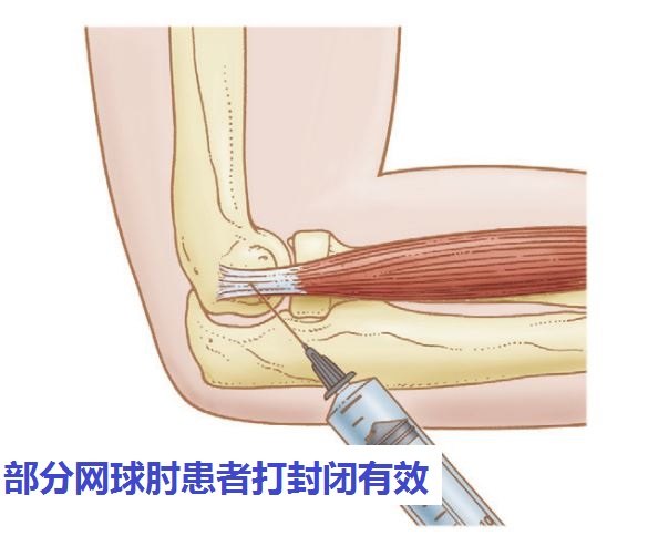 网球肘封闭注射图解图片