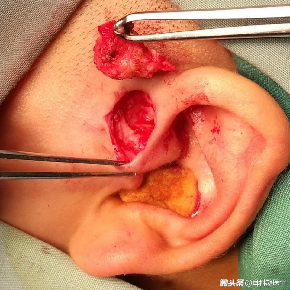 耳甲腔瘘管图片