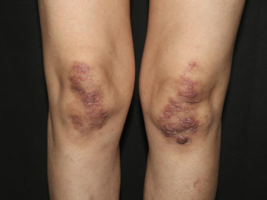 既往有类风湿性关节炎病史.