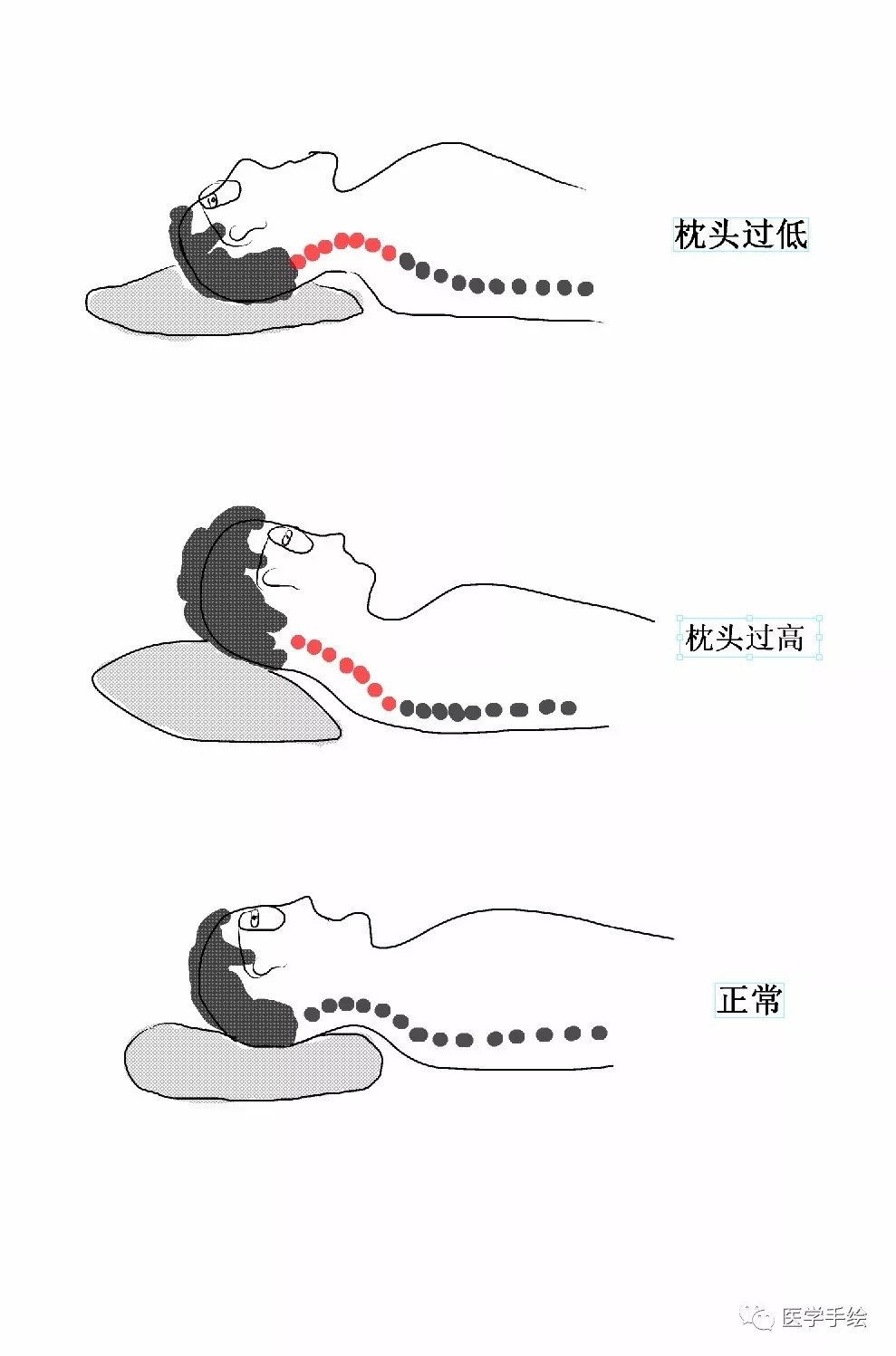 颈椎病患者如何选择枕头? 
