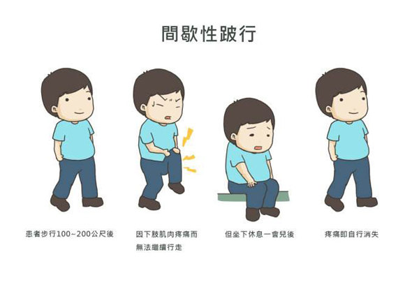 75岁刘爷爷半年前出现间歇性跛行,因为年老体弱,未引起家人的重视,一