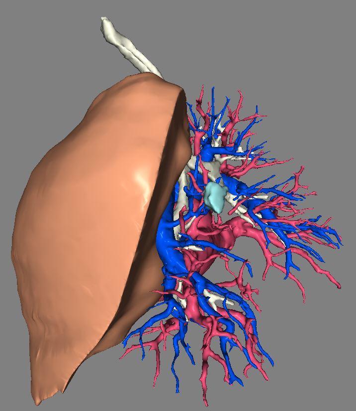 三维重建技术,助力精准微创手术——肺结节患者的福音 - 好大夫在线
