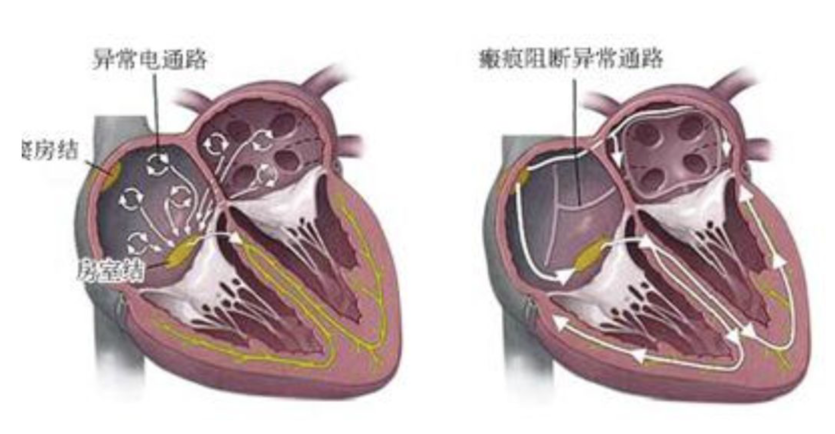 房颤与心衰 -- 一对难兄难弟