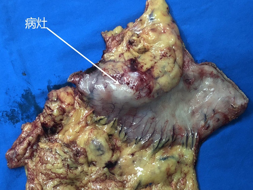 疣状胃炎手术图片