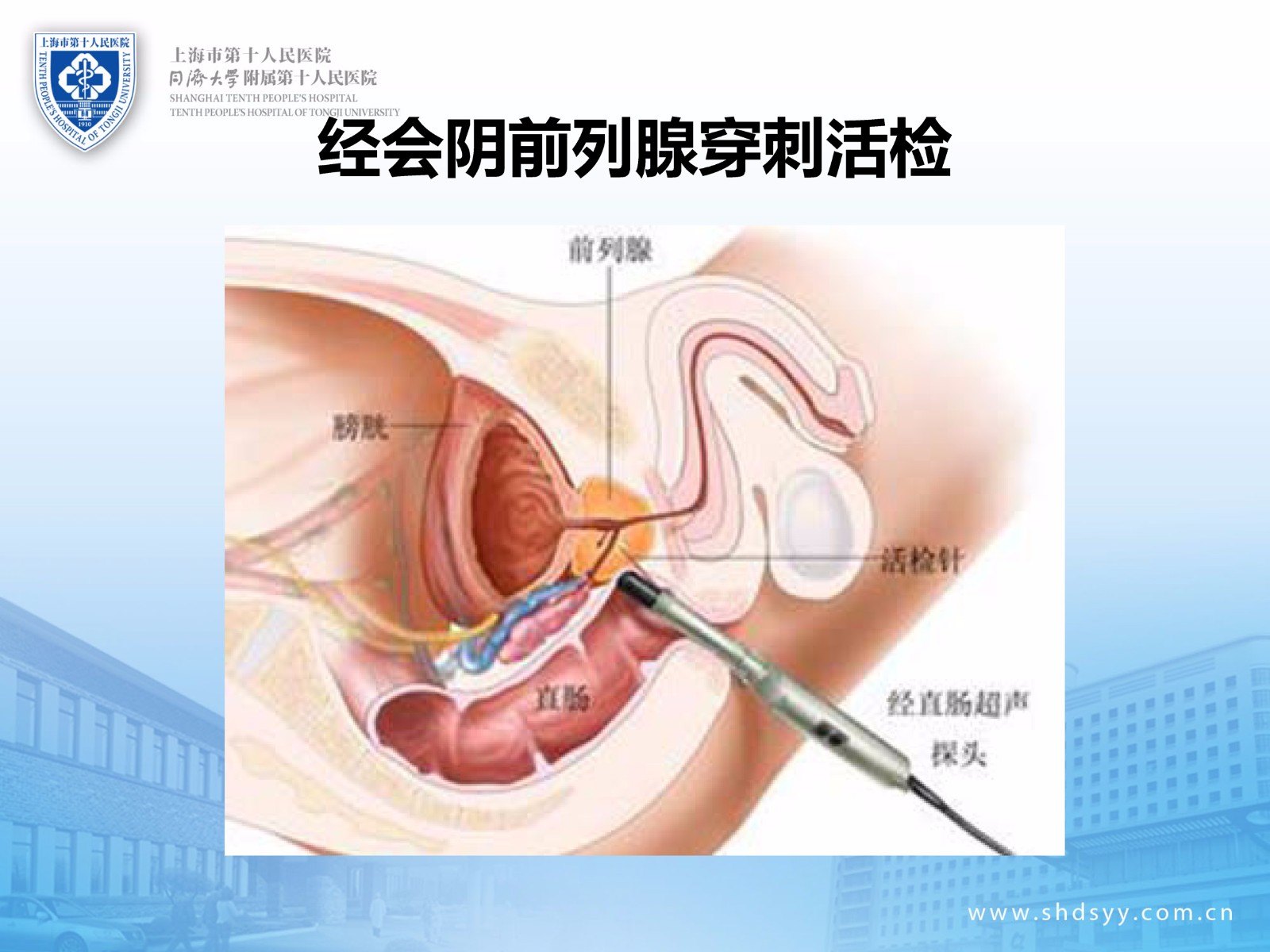 新技术介绍前列腺癌早期诊断的融合靶向精准穿刺活检