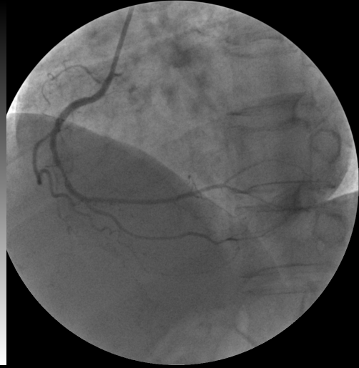 右侧冠状动脉中段严重狭窄一例