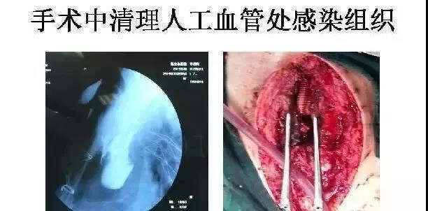 成人病例|人工大血管术后复杂纵隔感染治疗