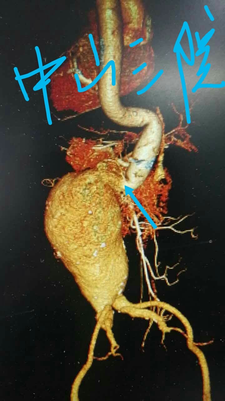 开放手术治疗腹主动脉瘤