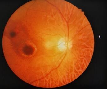 眼底出血之视网膜大动脉瘤