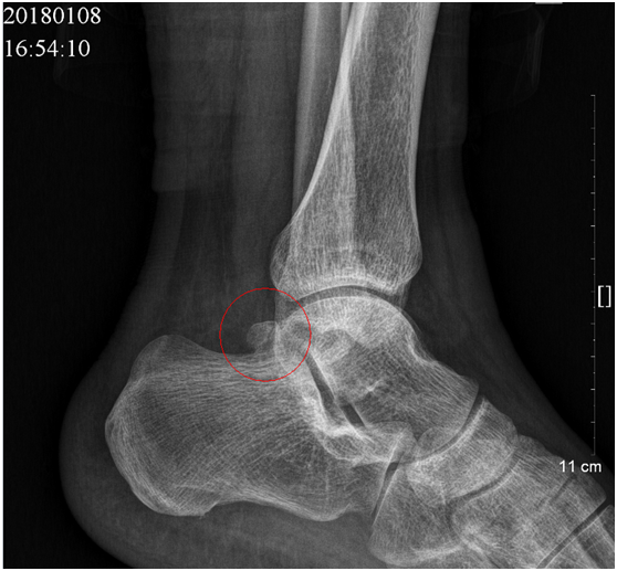 经过细致的查体并完善影像学检查,初步诊断:左后踝撞击综合征;左距骨