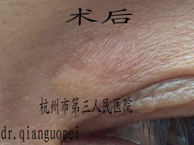 超脉冲二氧化碳激光治疗皮肤睑黄瘤(皮肤病系列五) 