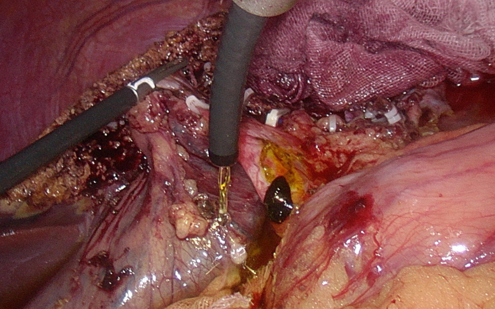 千枚胆囊结石的腹腔镜胆囊切除术1例