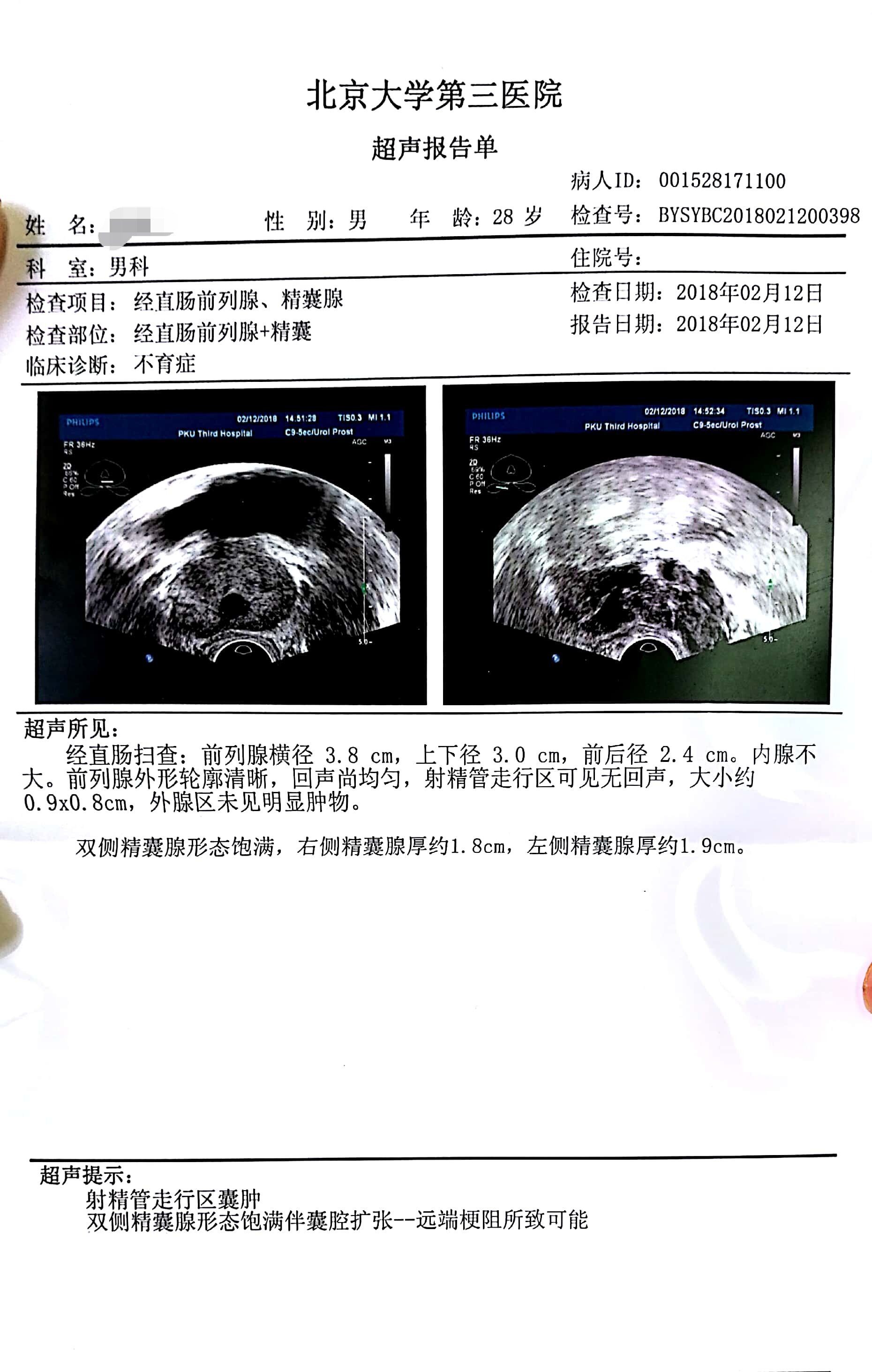 精囊腺超声图片图片