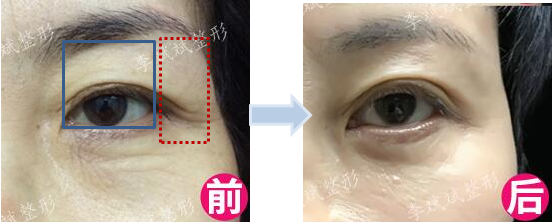 李斌斌手术实例——外眼角提升术详解及案例