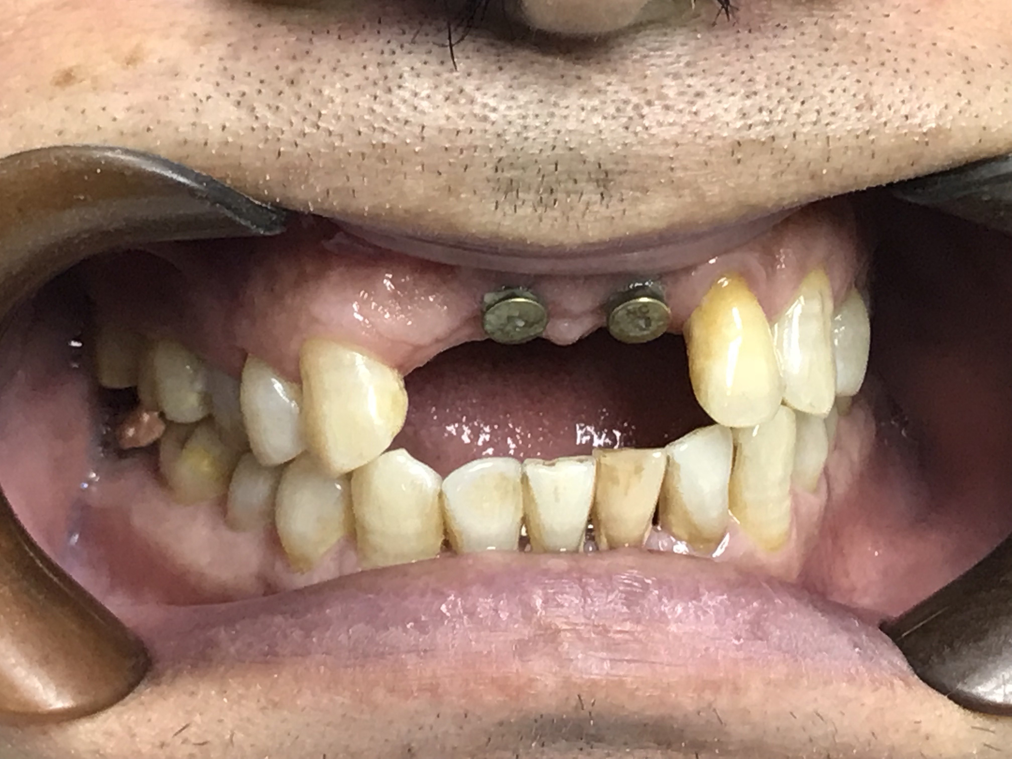 上颌骨囊肿及根尖囊肿摘除及上前牙拔除即刻种植分享 - 好大夫在线