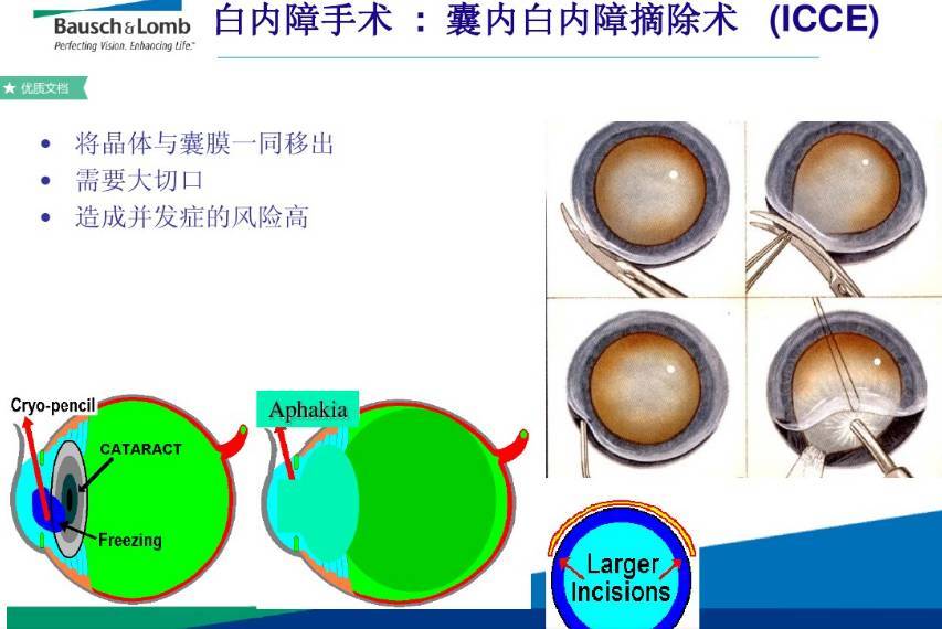最全总结:白内障手术基础知识