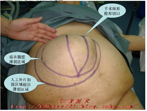 脐疝修补术图解图片
