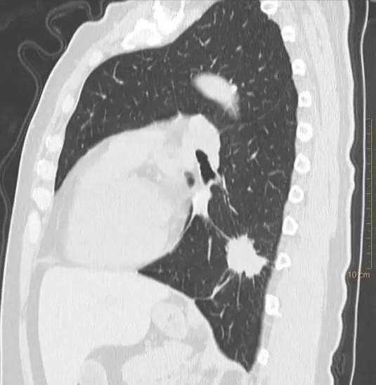 病例1:浸润性肺腺癌 - 好大夫在线