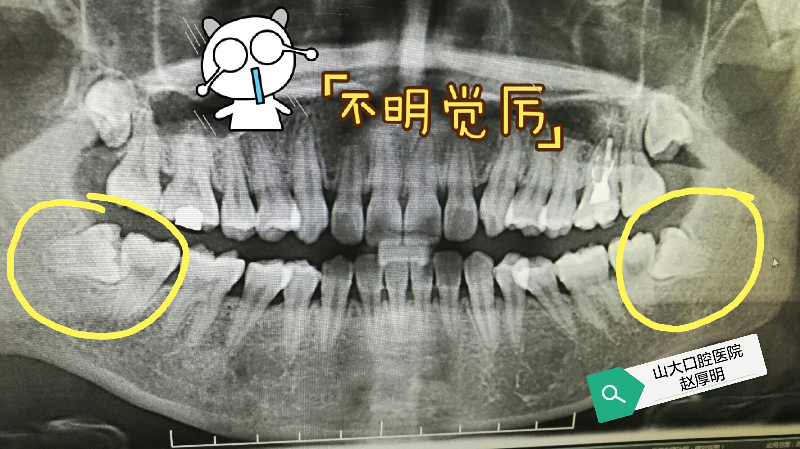 拔智齒後到底會腫痛多久