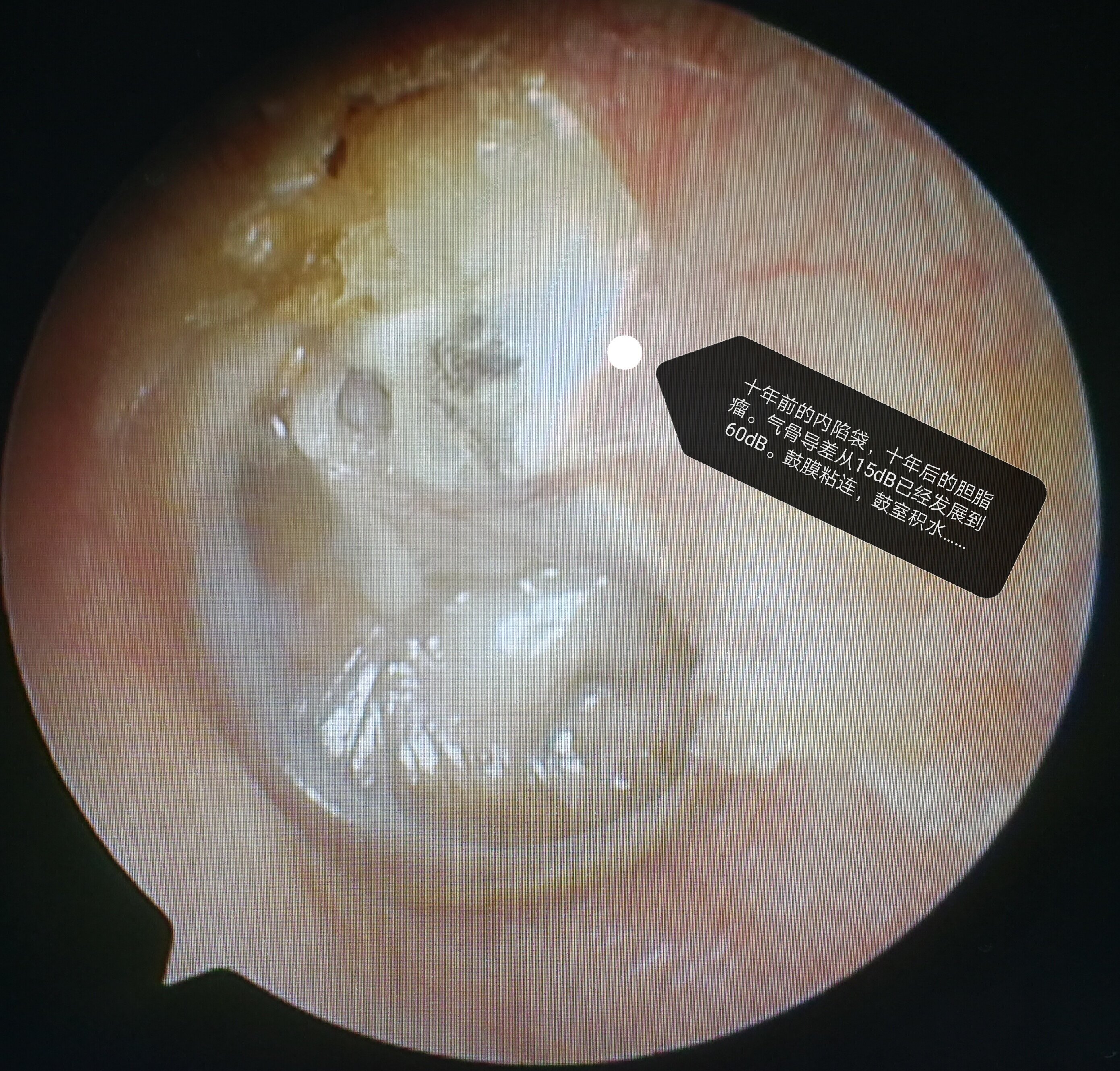 听骨链重建手术成功率图片