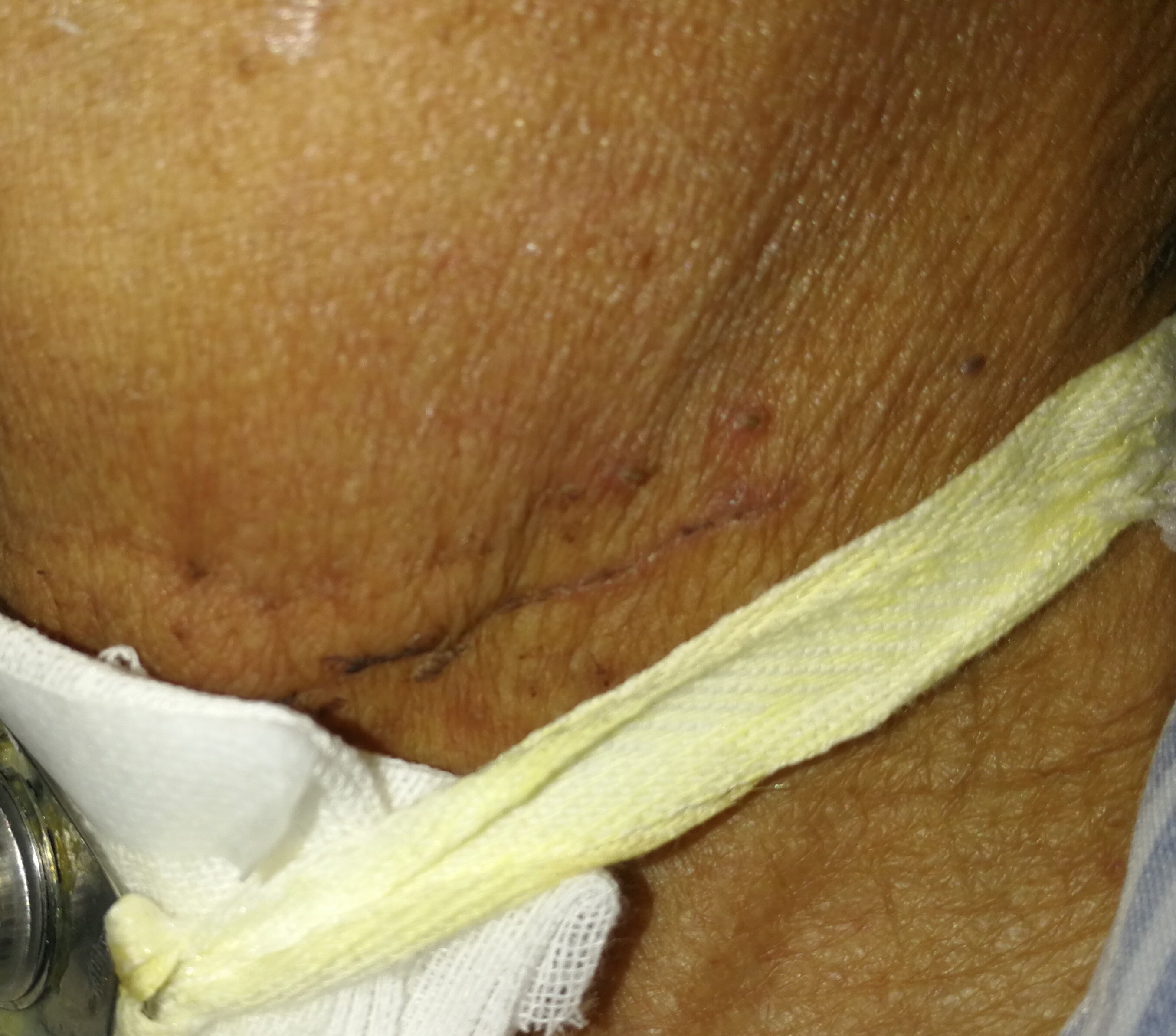 下咽癌术后图片图片