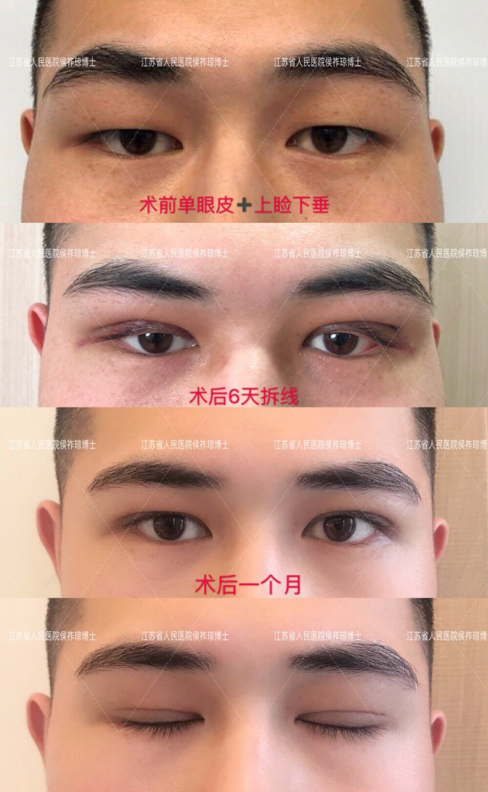 男生做双眼皮只是为了美观吗? - 好大夫在线