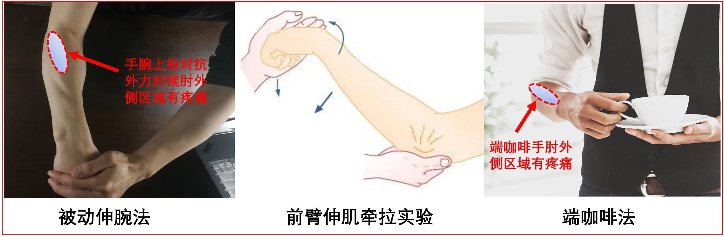 有一种胳膊痛叫 网球肘 网球肘 网球肘疾病介绍 好大夫在线 有一种胳膊痛叫 网球肘 网球肘 网球肘疾病介绍 好大夫在线