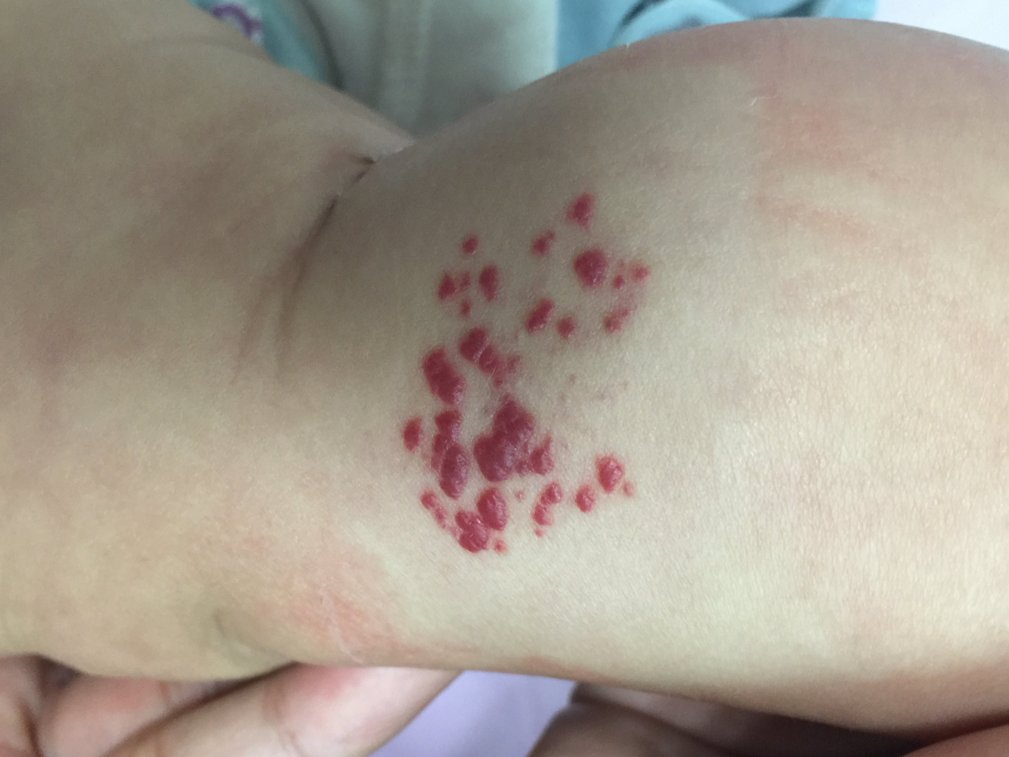 血管瘤激光治疗流程